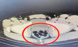 Midesinde 50 kapsül uyuşturucu ile yakalanan kadın gözaltında