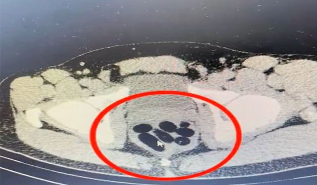 Midesinde 50 kapsül uyuşturucu ile yakalanan kadın gözaltında